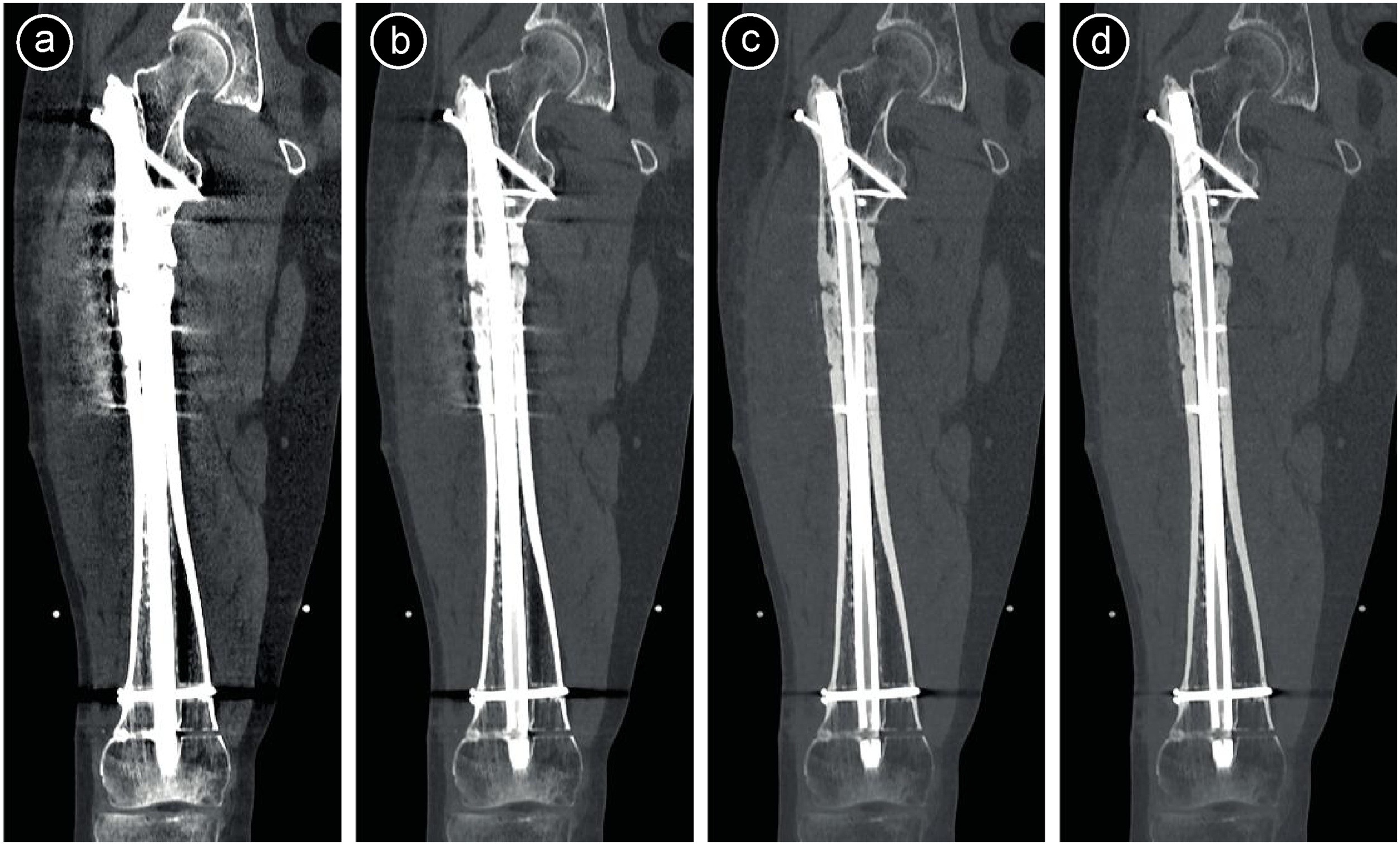Metal Artifact Reduction